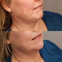 agneslowerfacebeforeafter2