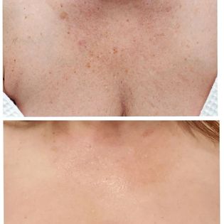 intense pulsed light