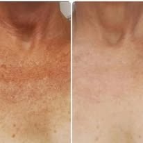 intense pulsed light