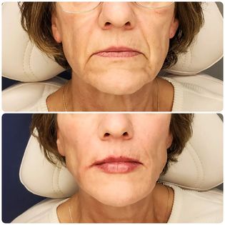 lower face filler